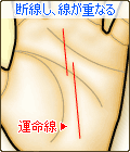 運命線が断線して、線が重なる