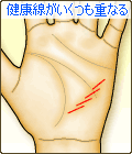 健康線がいくつも重なる