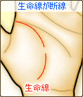 生命線が断線する