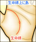 生命線上に島(アイランド)がある