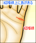 結婚線の上に島(アイランド)がある